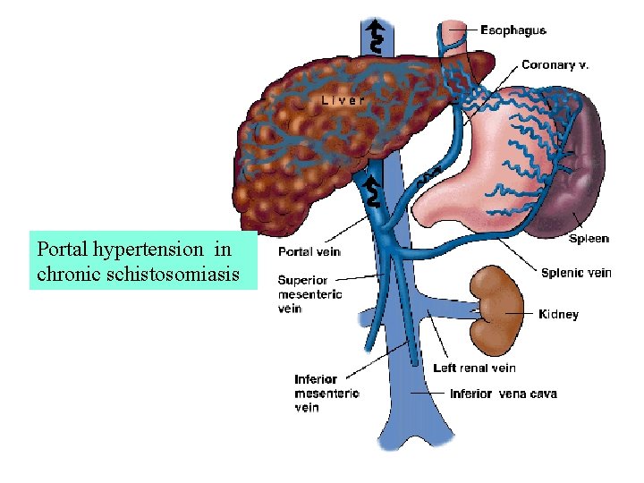 Portal hypertension in chronic schistosomiasis Portal hypertension in chronic schistosomiasis