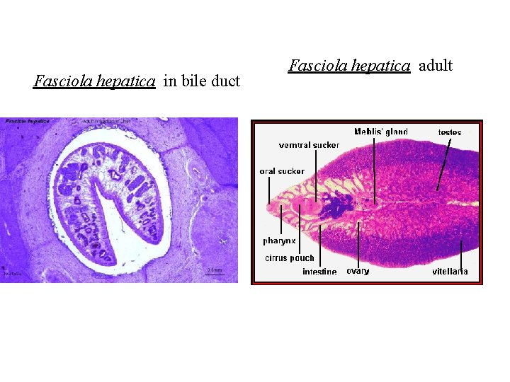 Fasciola hepatica in bile duct Fasciola hepatica adult Fasciola hepatica in bile duct Fasciola hepatica adult