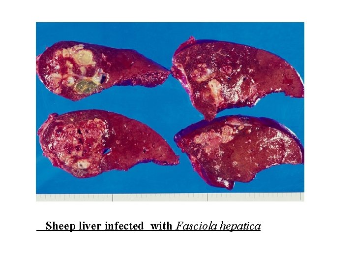 Sheep liver infected with Fasciola hepatica Sheep liver infected with Fasciola hepatica