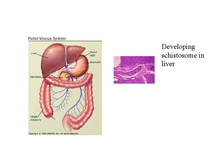 Developing schistosome in liver Developing schistosome in liver