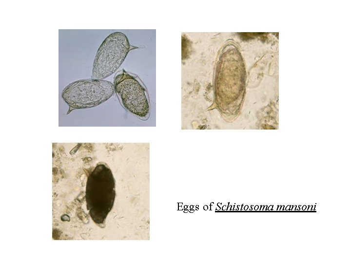 Eggs of Schistosoma mansoni Eggs of Schistosoma mansoni