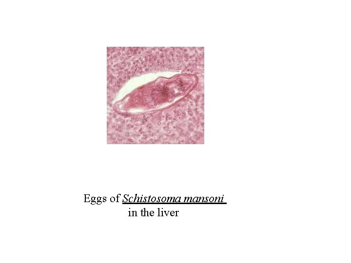 Eggs of Schistosoma mansoni in the liver Eggs of Schistosoma mansoni in the liver