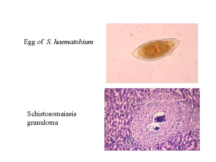 Egg of S. haematobium Schistosomaiasis granuloma Egg of S. haematobium Schistosomaiasis granuloma