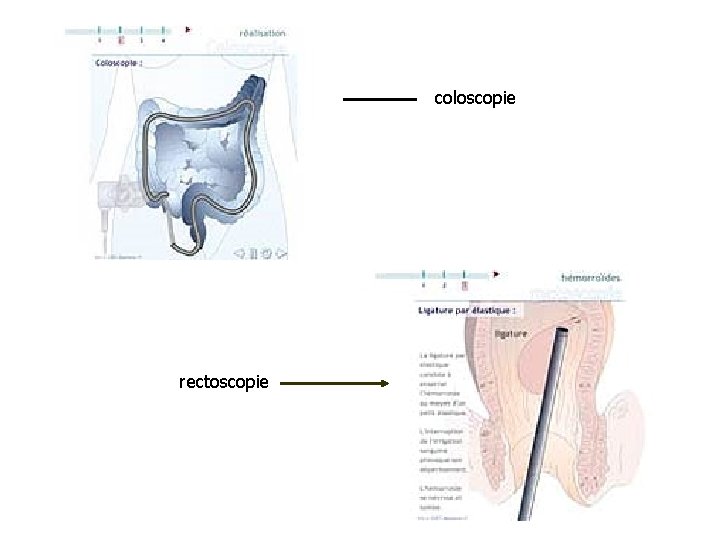 coloscopie rectoscopie 