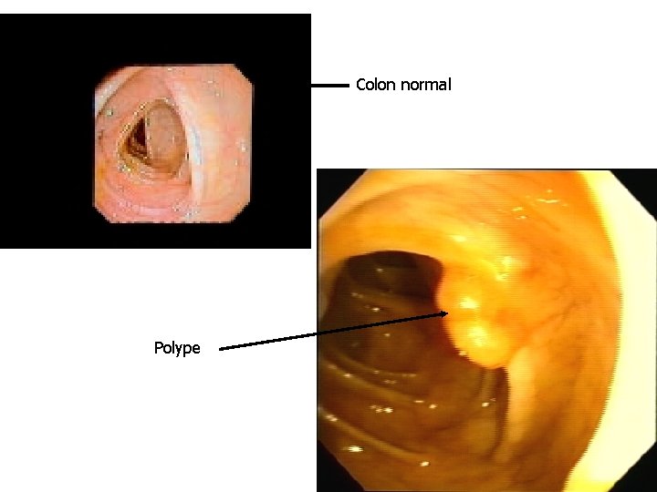 Colon normal Polype 