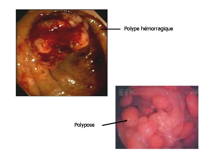 Polype hémorragique Polypose 