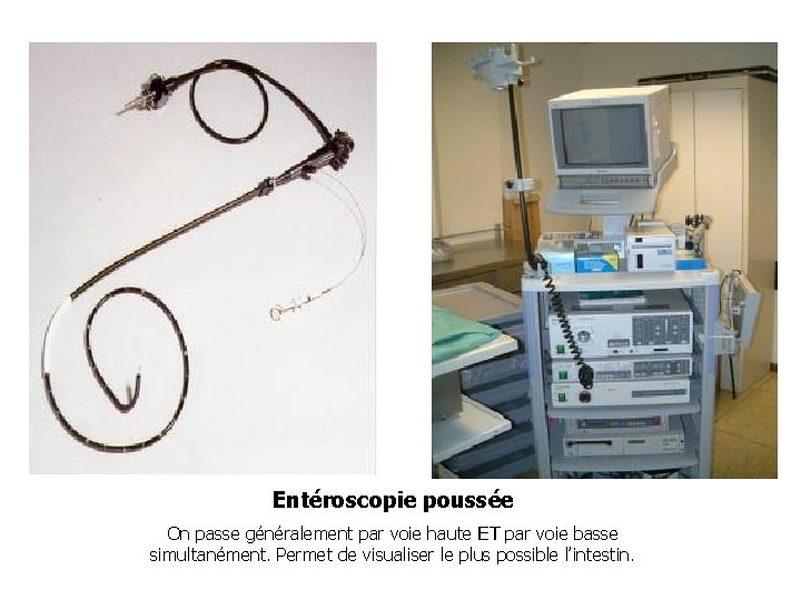 Entéroscopie poussée On passe généralement par voie haute ET par voie basse simultanément. Permet