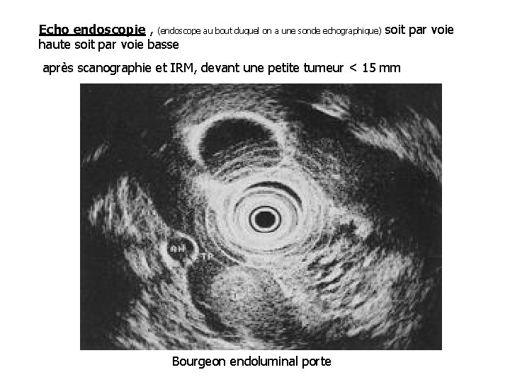 Echo endoscopie , (endoscope au bout duquel on a une sonde echographique) soit par