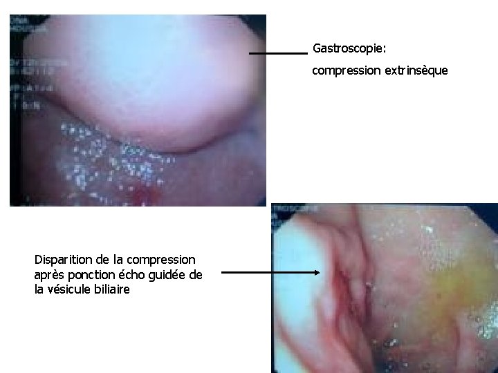 Gastroscopie: compression extrinsèque Disparition de la compression après ponction écho guidée de la vésicule