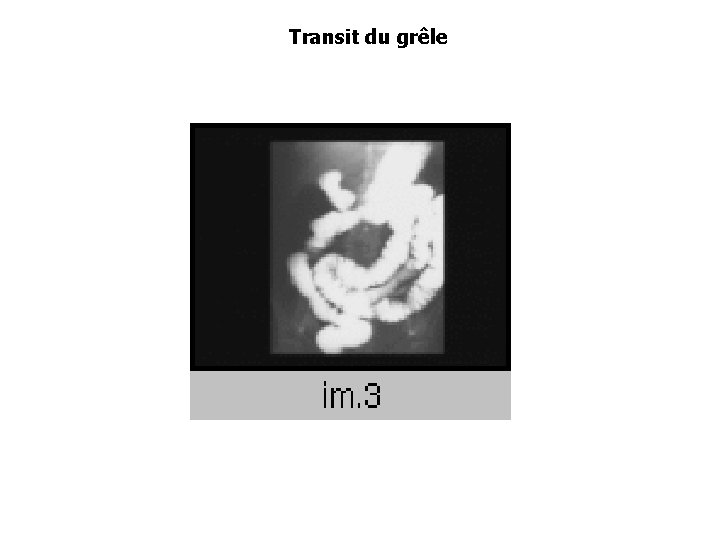 Transit du grêle 