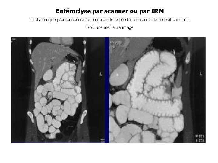 Entéroclyse par scanner ou par IRM Intubation jusqu’au duodénum et on projette le produit