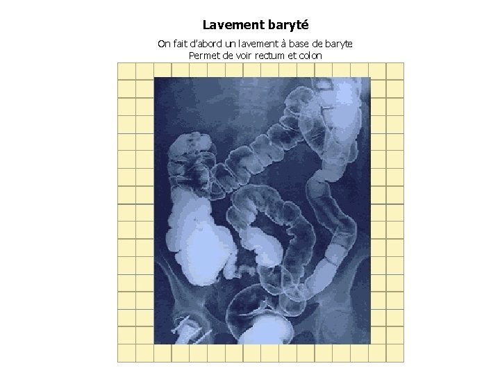 Lavement baryté On fait d’abord un lavement à base de baryte Permet de voir