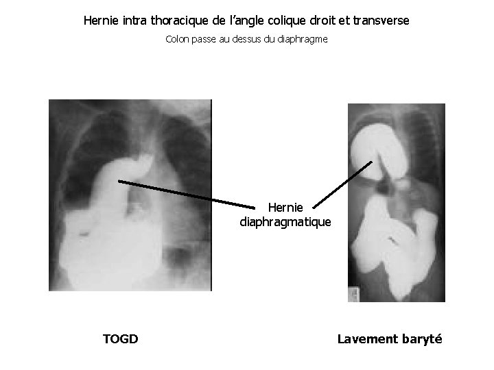 Hernie intra thoracique de l’angle colique droit et transverse Colon passe au dessus du