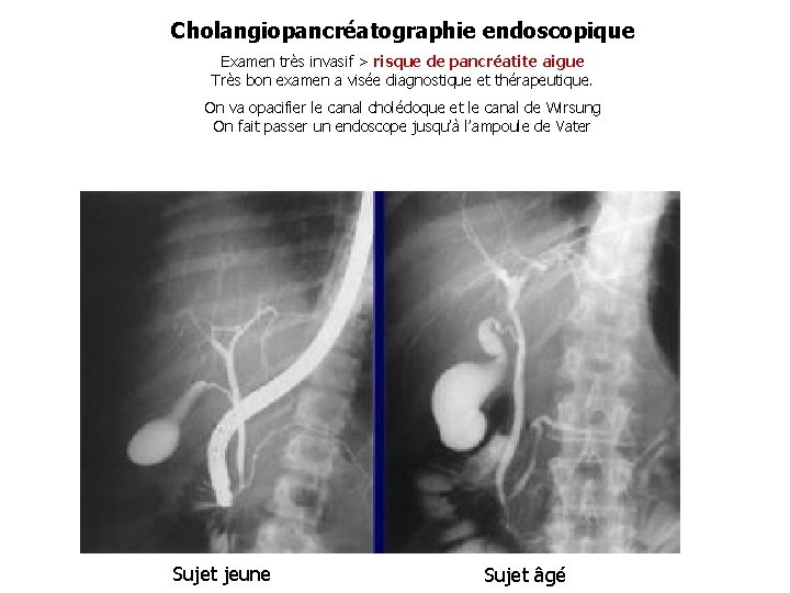 Cholangiopancréatographie endoscopique Examen très invasif > risque de pancréatite aigue Très bon examen a