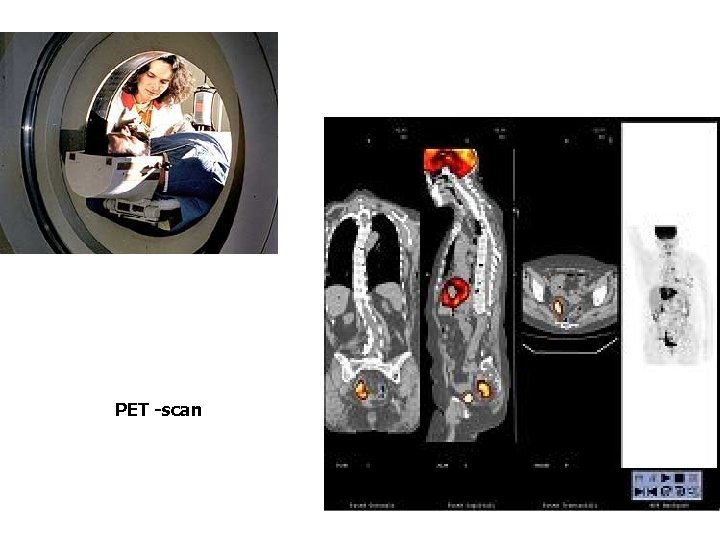 PET -scan 