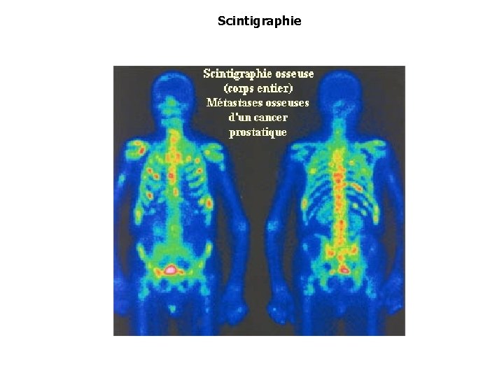 Scintigraphie 