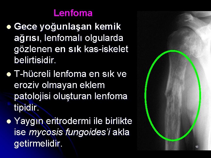Lenfoma l Gece yoğunlaşan kemik ağrısı, lenfomalı olgularda gözlenen en sık kas-iskelet belirtisidir. l Lenfoma l Gece yoğunlaşan kemik ağrısı, lenfomalı olgularda gözlenen en sık kas-iskelet belirtisidir. l