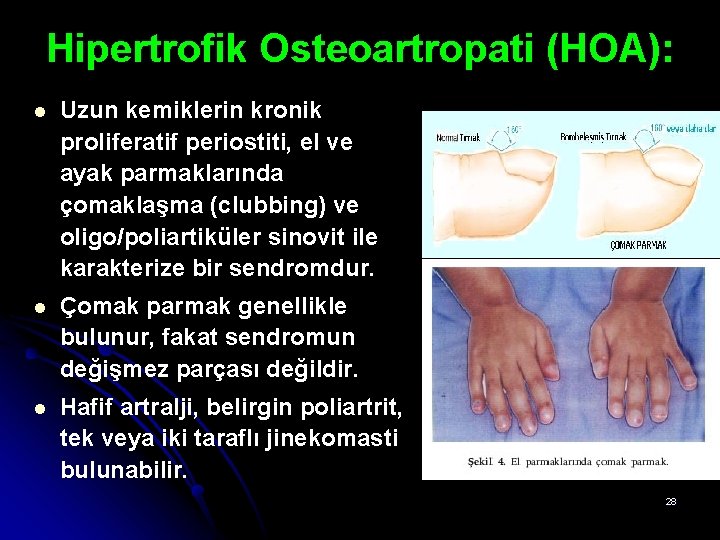 Hipertrofik Osteoartropati (HOA): l Uzun kemiklerin kronik proliferatif periostiti, el ve ayak parmaklarında çomaklaşma Hipertrofik Osteoartropati (HOA): l Uzun kemiklerin kronik proliferatif periostiti, el ve ayak parmaklarında çomaklaşma