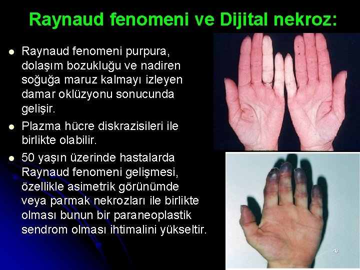 Raynaud fenomeni ve Dijital nekroz: l l l Raynaud fenomeni purpura, dolaşım bozukluğu ve Raynaud fenomeni ve Dijital nekroz: l l l Raynaud fenomeni purpura, dolaşım bozukluğu ve