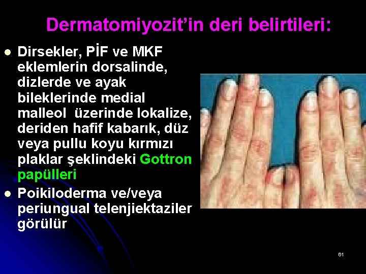 Dermatomiyozit’in deri belirtileri: l l Dirsekler, PİF ve MKF eklemlerin dorsalinde, dizlerde ve ayak Dermatomiyozit’in deri belirtileri: l l Dirsekler, PİF ve MKF eklemlerin dorsalinde, dizlerde ve ayak