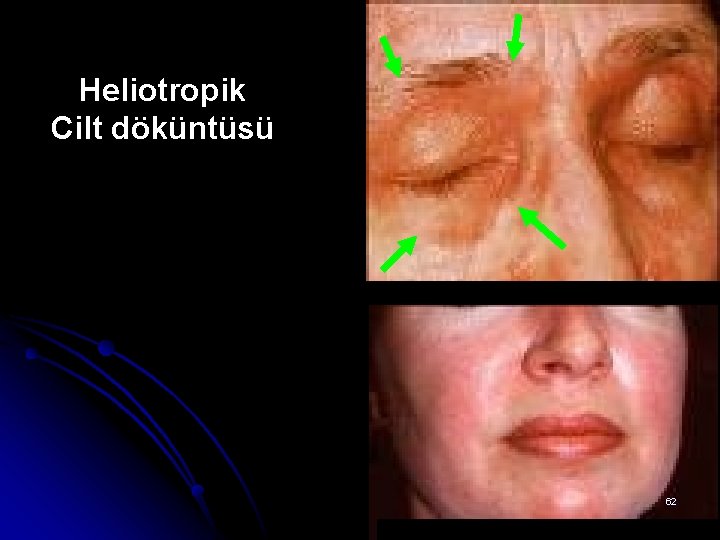 Heliotropik Cilt döküntüsü 62 Heliotropik Cilt döküntüsü 62