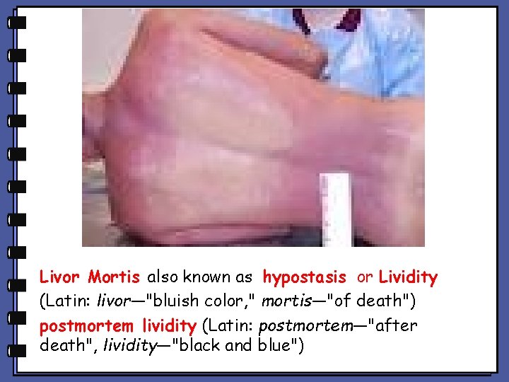 Livor Mortis also known as hypostasis or Lividity (Latin: livor—"bluish color, " mortis—"of death") Livor Mortis also known as hypostasis or Lividity (Latin: livor—"bluish color, " mortis—"of death")
