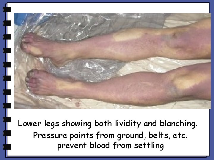 Lower legs showing both lividity and blanching. Pressure points from ground, belts, etc. prevent Lower legs showing both lividity and blanching. Pressure points from ground, belts, etc. prevent