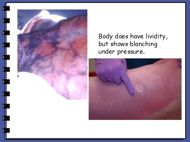 Body does have lividity, but shows blanching under pressure. Body does have lividity, but shows blanching under pressure.