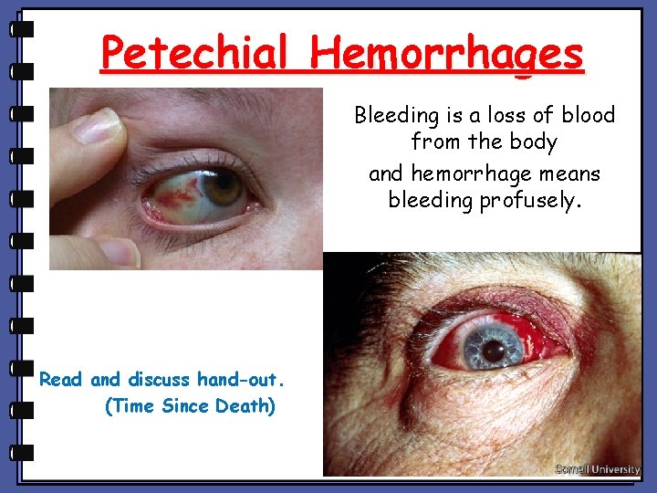 Petechial Hemorrhages Bleeding is a loss of blood from the body and hemorrhage means Petechial Hemorrhages Bleeding is a loss of blood from the body and hemorrhage means