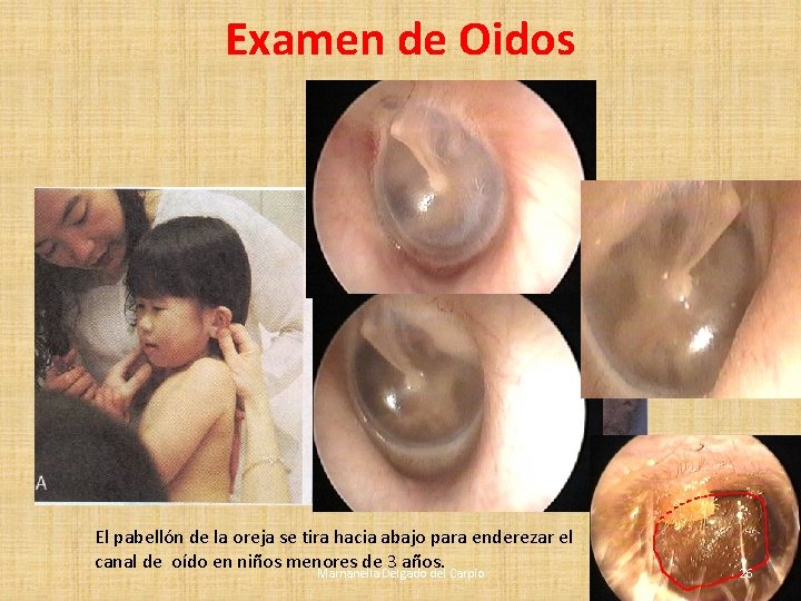 Examen de Oidos El pabellón de la oreja se tira hacia abajo para enderezar Examen de Oidos El pabellón de la oreja se tira hacia abajo para enderezar