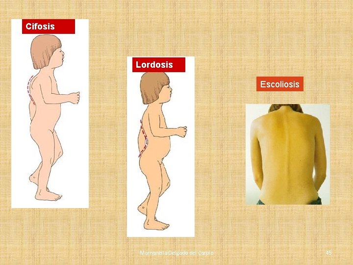 Cifosis Lordosis Escoliosis Marnanella Delgado del Carpio 45 Cifosis Lordosis Escoliosis Marnanella Delgado del Carpio 45