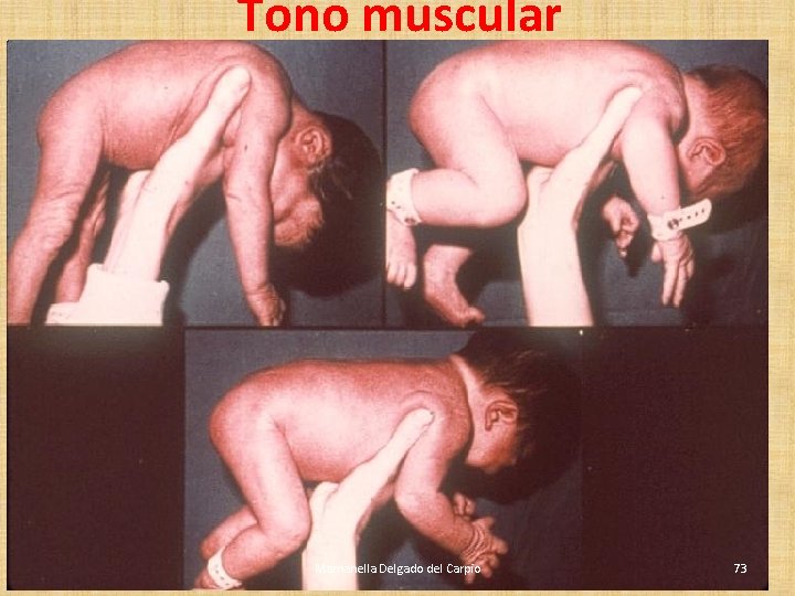 Tono muscular Marnanella Delgado del Carpio 73 Tono muscular Marnanella Delgado del Carpio 73