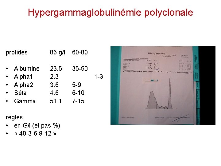 Hypergammaglobulinémie polyclonale protides 85 g/l • • • 23. 5 35 -50 2. 3
