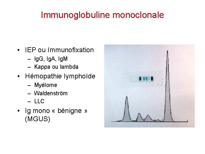 Immunoglobuline monoclonale • IEP ou Immunofixation – Ig. G, Ig. A, Ig. M –