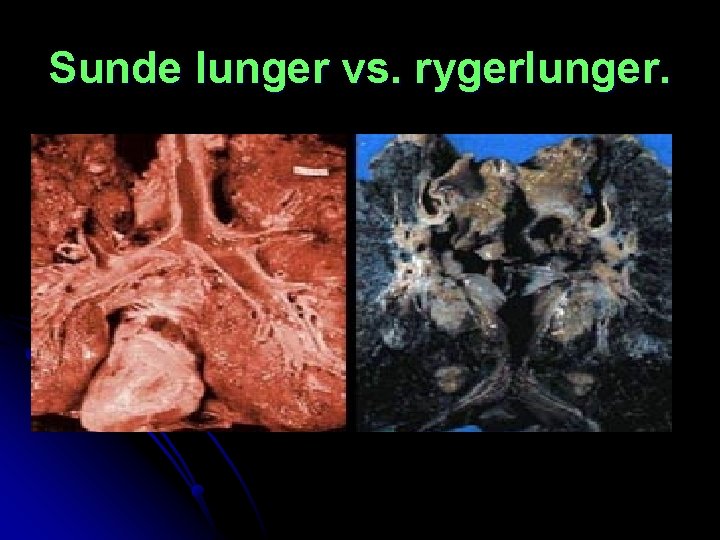 Sunde lunger vs. rygerlunger. 