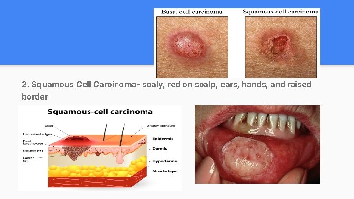 2. Squamous Cell Carcinoma- scaly, red on scalp, ears, hands, and raised border 