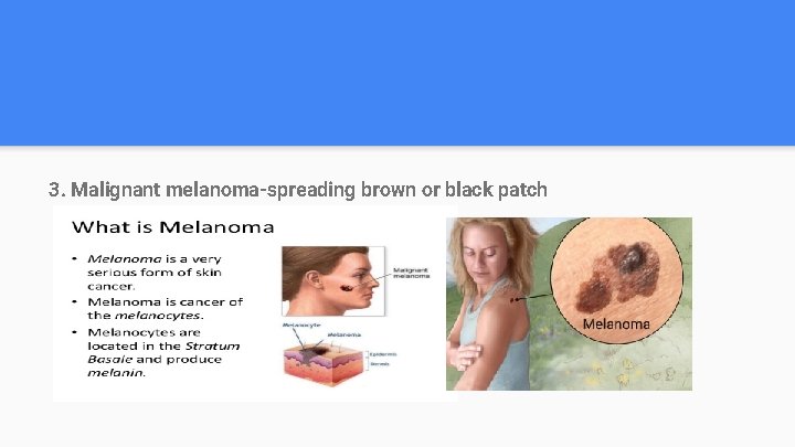 3. Malignant melanoma-spreading brown or black patch 