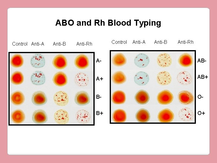 ABO and Rh Blood Typing Control Anti-A Anti-B Control Anti-Rh Anti-A Anti-B Anti-Rh A-