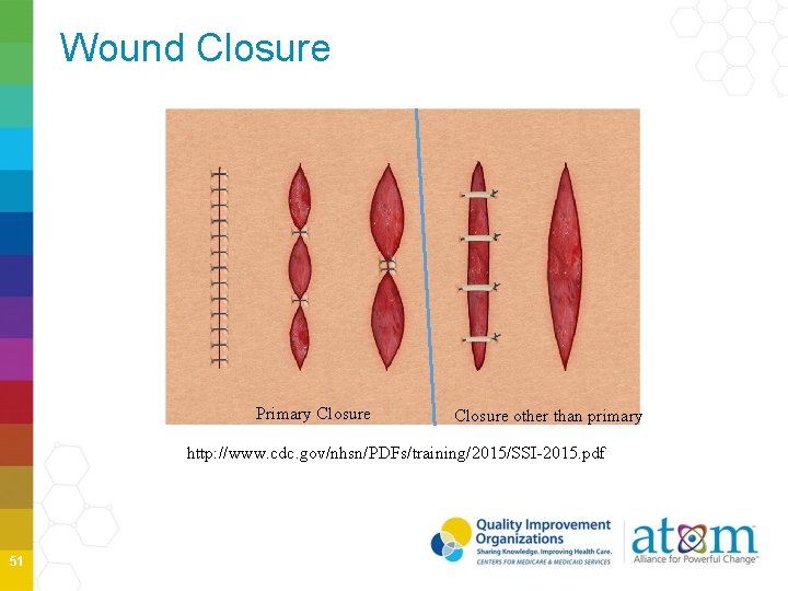 Wound Closure Primary Closure other than primary http: //www. cdc. gov/nhsn/PDFs/training/2015/SSI-2015. pdf 51 
