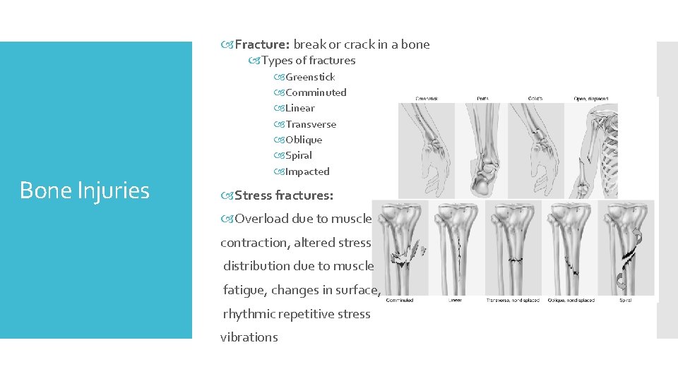  Fracture: break or crack in a bone Types of fractures Bone Injuries Greenstick