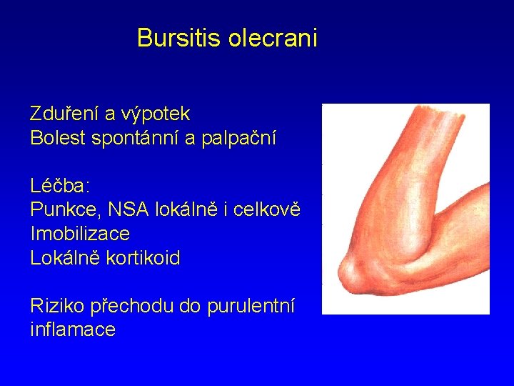 Bursitis olecrani Zduření a výpotek Bolest spontánní a palpační Léčba: Punkce, NSA lokálně i