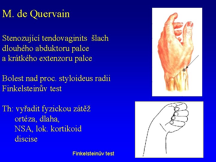 M. de Quervain Stenozující tendovaginits šlach dlouhého abduktoru palce a krátkého extenzoru palce Bolest