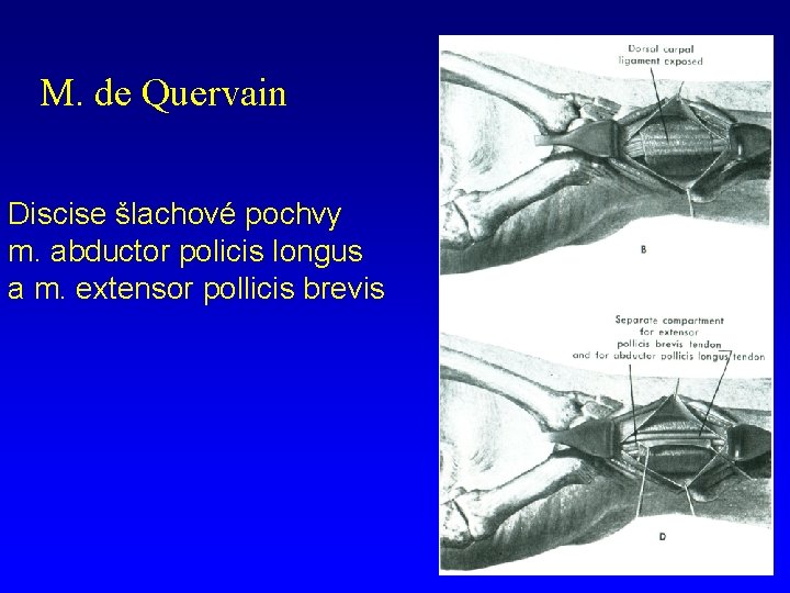 M. de Quervain Discise šlachové pochvy m. abductor policis longus a m. extensor pollicis
