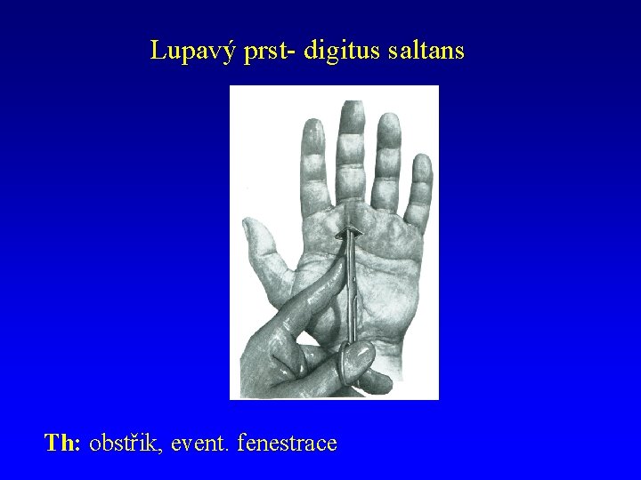 Lupavý prst- digitus saltans Th: obstřik, event. fenestrace 