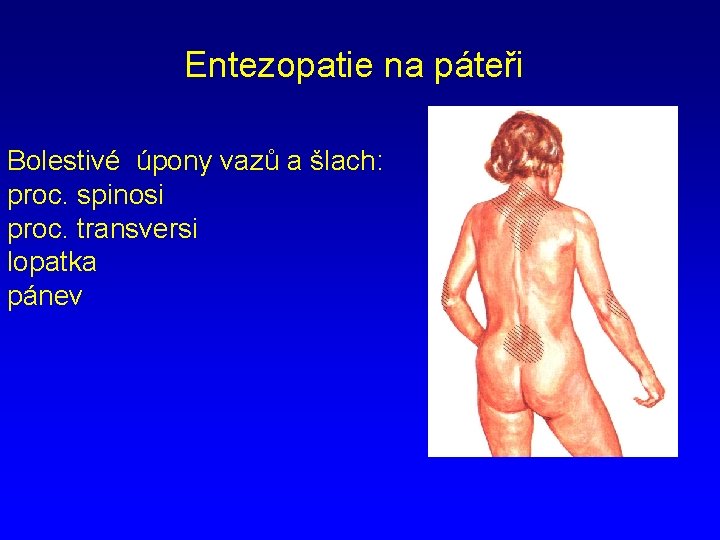 Entezopatie na páteři Bolestivé úpony vazů a šlach: proc. spinosi proc. transversi lopatka pánev