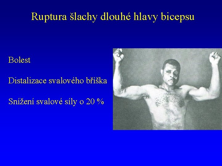 Ruptura šlachy dlouhé hlavy bicepsu Bolest Distalizace svalového bříška Snížení svalové síly o 20