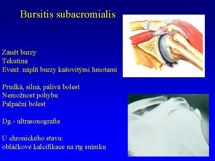 Bursitis subacromialis Zánět burzy Tekutina Event. náplň burzy kašovitými hmotami Prudká, silná, pálivá bolest