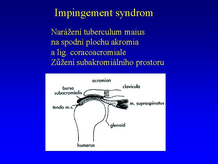 Impingement syndrom Narážení tuberculum maius na spodní plochu akromia a lig. coracoacromiale Zůžení subakromiálního