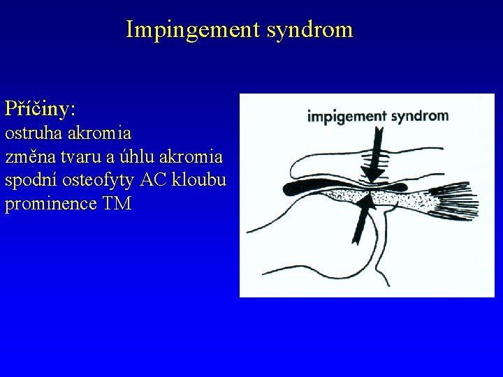 Impingement syndrom Příčiny: ostruha akromia změna tvaru a úhlu akromia spodní osteofyty AC kloubu