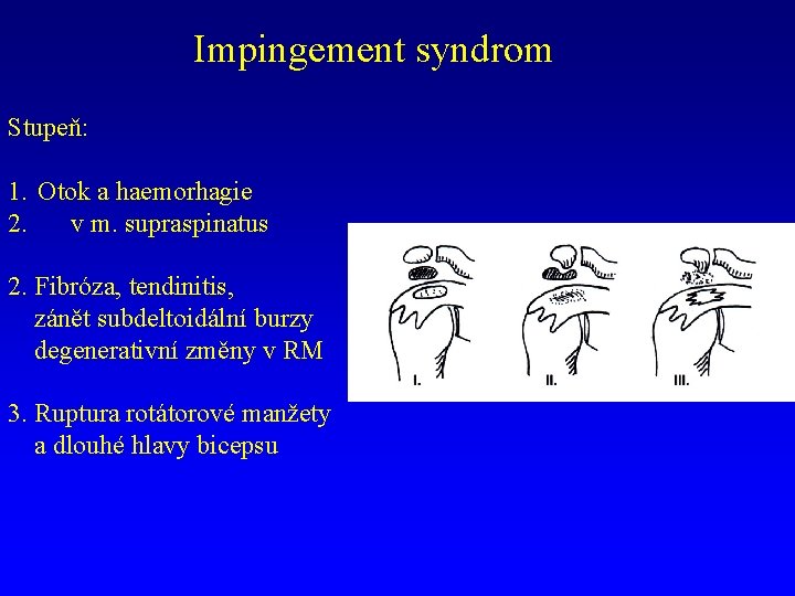 Impingement syndrom Stupeň: 1. Otok a haemorhagie 2. v m. supraspinatus 2. Fibróza, tendinitis,